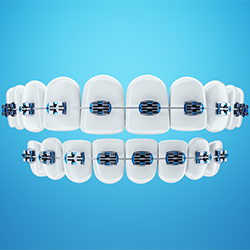 تقويم الأسنان