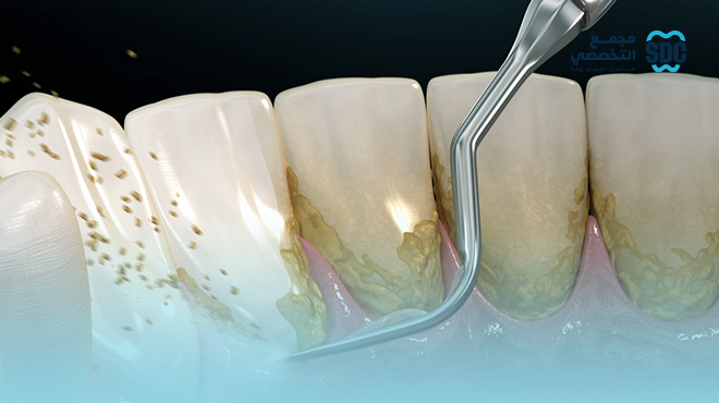 عروض-تنظيف-الأسنان-جدة