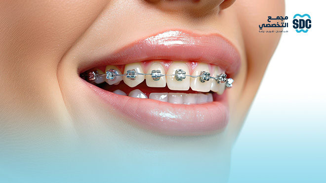 شروط تركيب تقويم الأسنان: ما يجب معرفته قبل البدء بالعلاج
