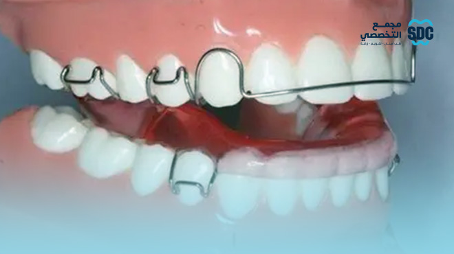 سعر-مثبت-الأسنان-بعد-التقويم-بالريال