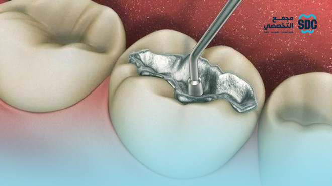 دليلك الشامل حول انواع حشوات الاسنان وافضلها