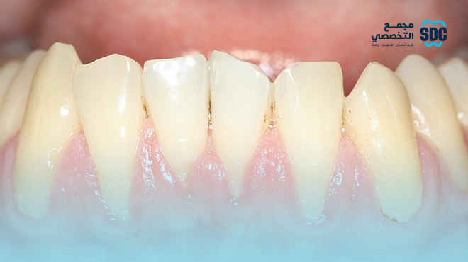 أسرار المرض الصامت: علاج انحسار اللثة