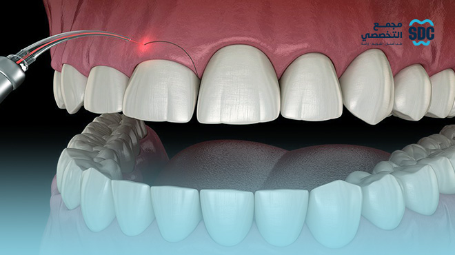 قص-اللثة-بالليزر