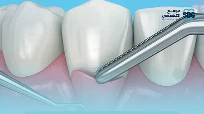 قص-اللثة-بالليزر