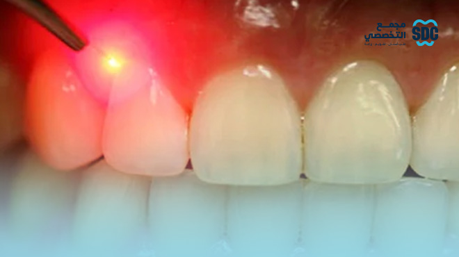 قص-اللثة-بالليزر
