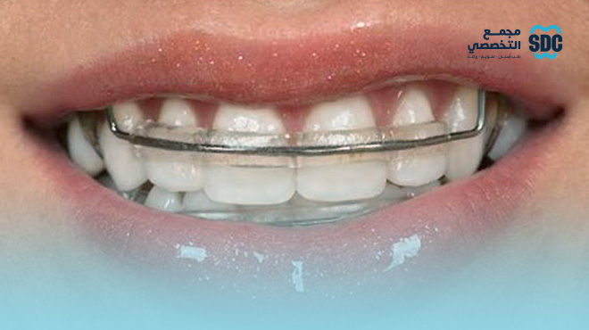 سعر-مثبت-الأسنان-بعد-التقويم-بالريال