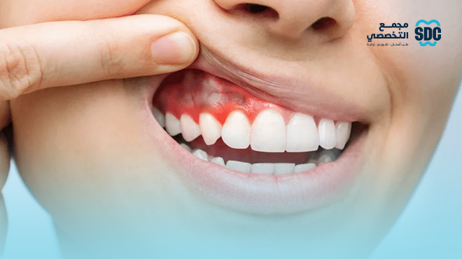 مشاكل-اللثة-و-الفم-في-رمضان