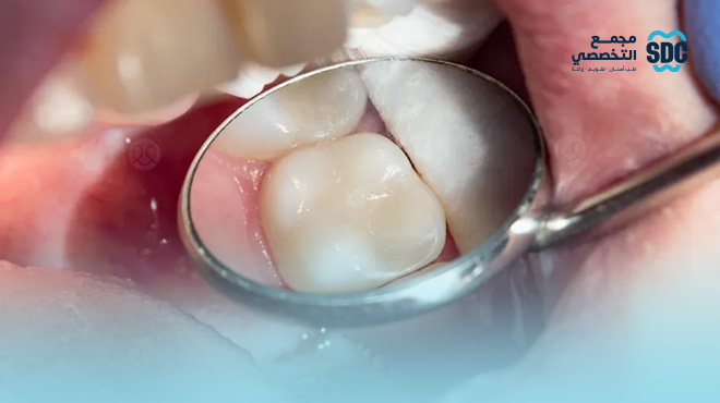 انواع-حشوات-الاسنان-وافضلها انواع-حشوات-الاسنان-وافضلها