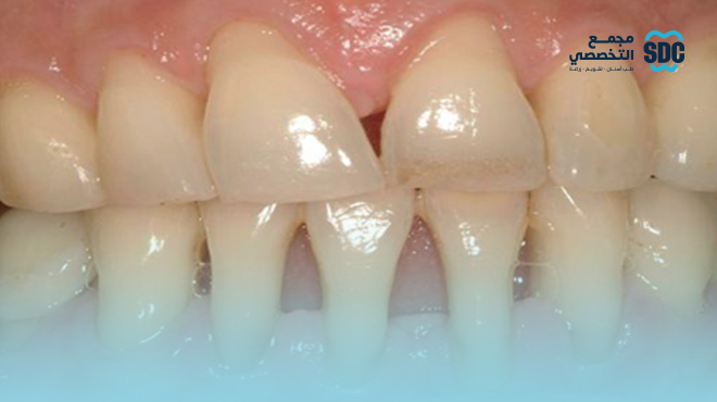 علاج-انحسار-اللثة