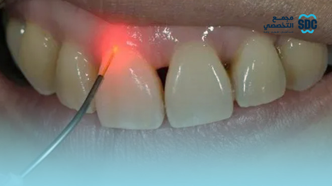 تعليمات-بعد-قص-اللثة-بالليزر