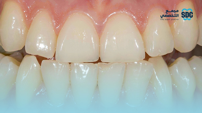 الفرق-بين-الحشوات-التجميلية-والفينير