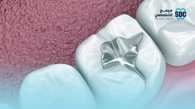 انواع-حشوات-الاسنان-وافضلها انواع-حشوات-الاسنان-وافضلها