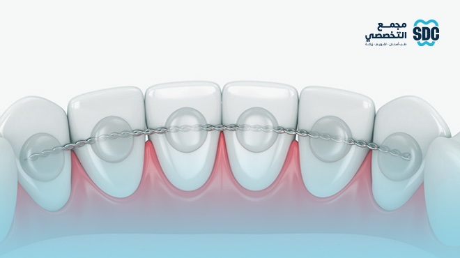 سعر-مثبت-الأسنان-بعد-التقويم-بالريال