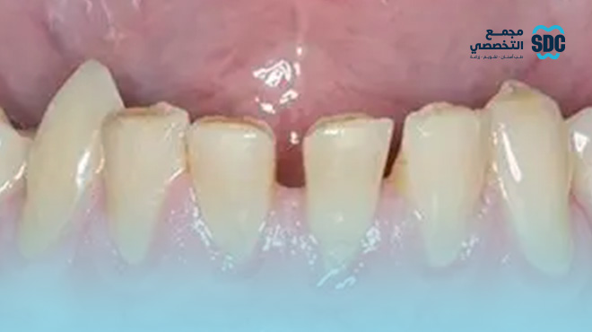 اعراض-انحسار-اللثة