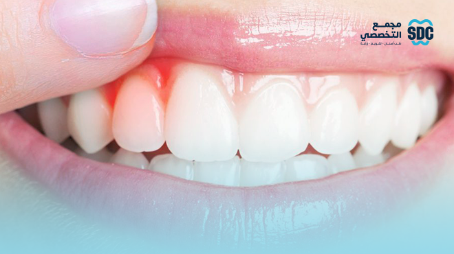 مشاكل-اللثة-و-الفم-في-رمضان