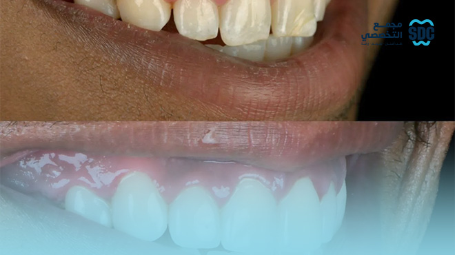 عروض-تنظيف-الاسنان-جدة