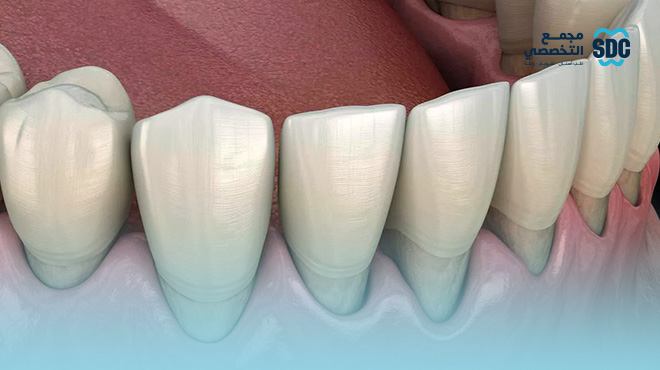 اسباب-انحسار-اللثة