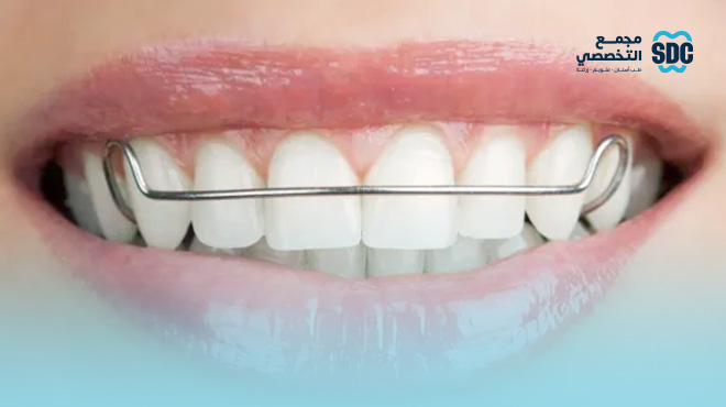 سعر-مثبت-الأسنان-بعد-التقويم-بالريال