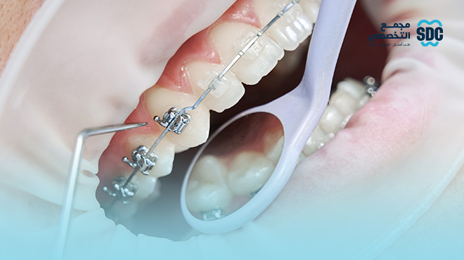 شروط-تركيب-تقويم-الأسنان
